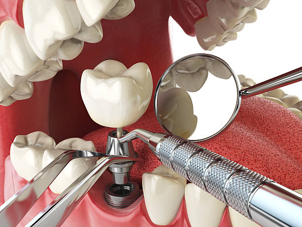 Best Emergency Tooth Extraction in Pryor Creek, OK